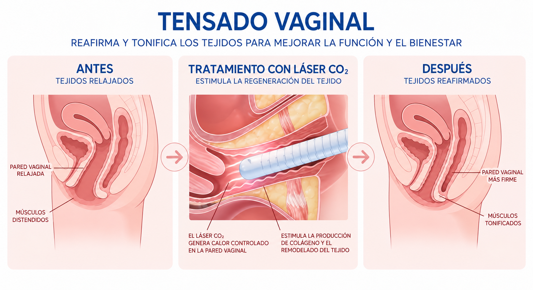 Infografía comparativa antes y después del tensado vaginal con láser CO2